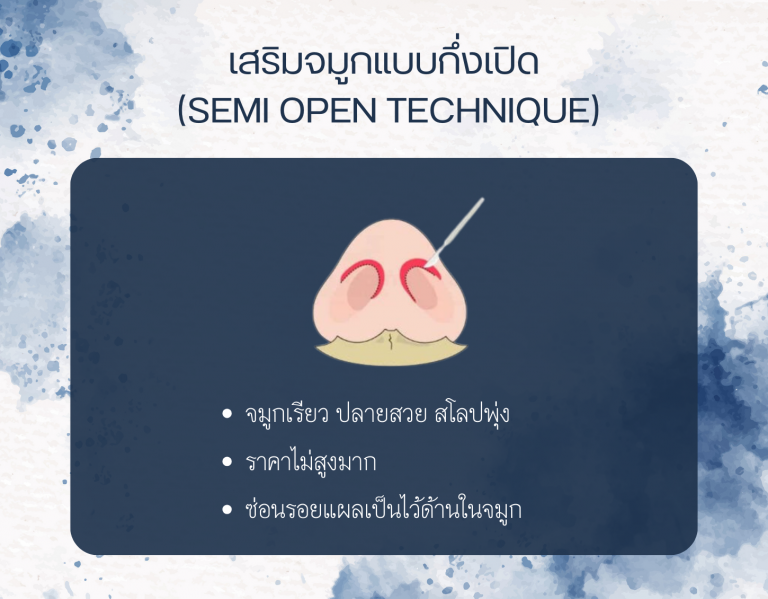 เสริมจมูกแบบกึ่งเปิด