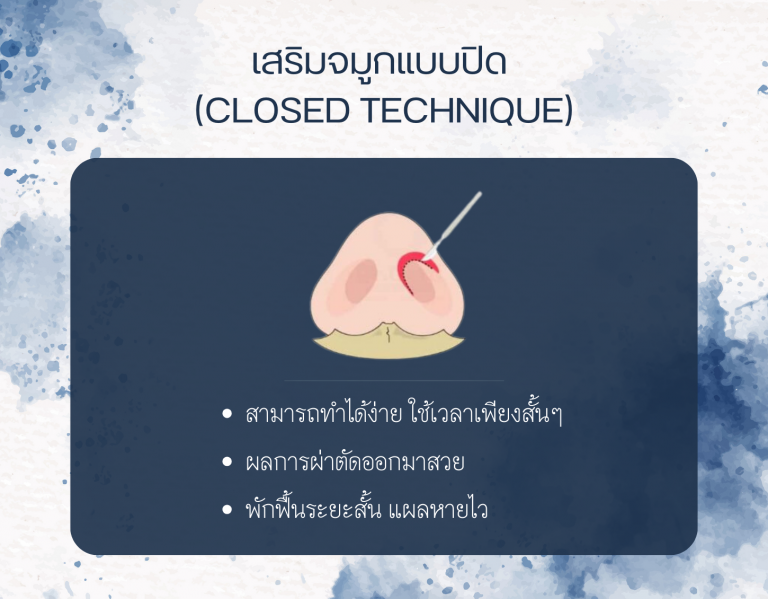 เสริมจมูกแบบปิด