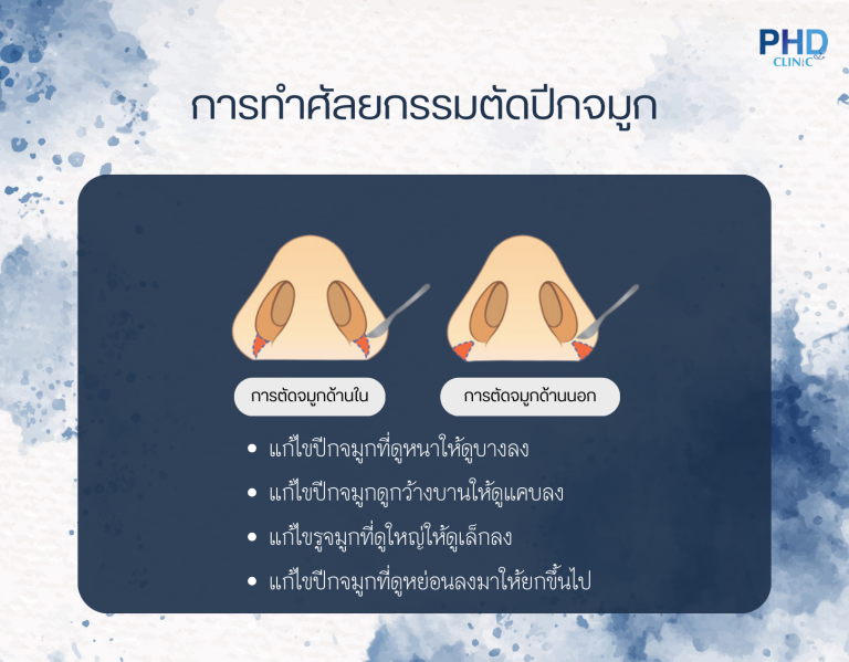 การทำศัลยกรรมตัดปีกจมูก​