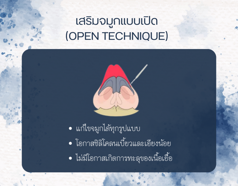 เสริมจมูกแบบเปิด