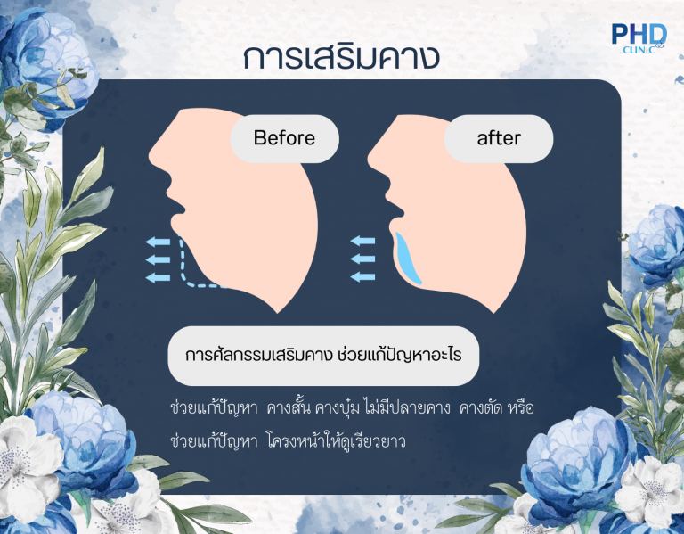เสริมคาง