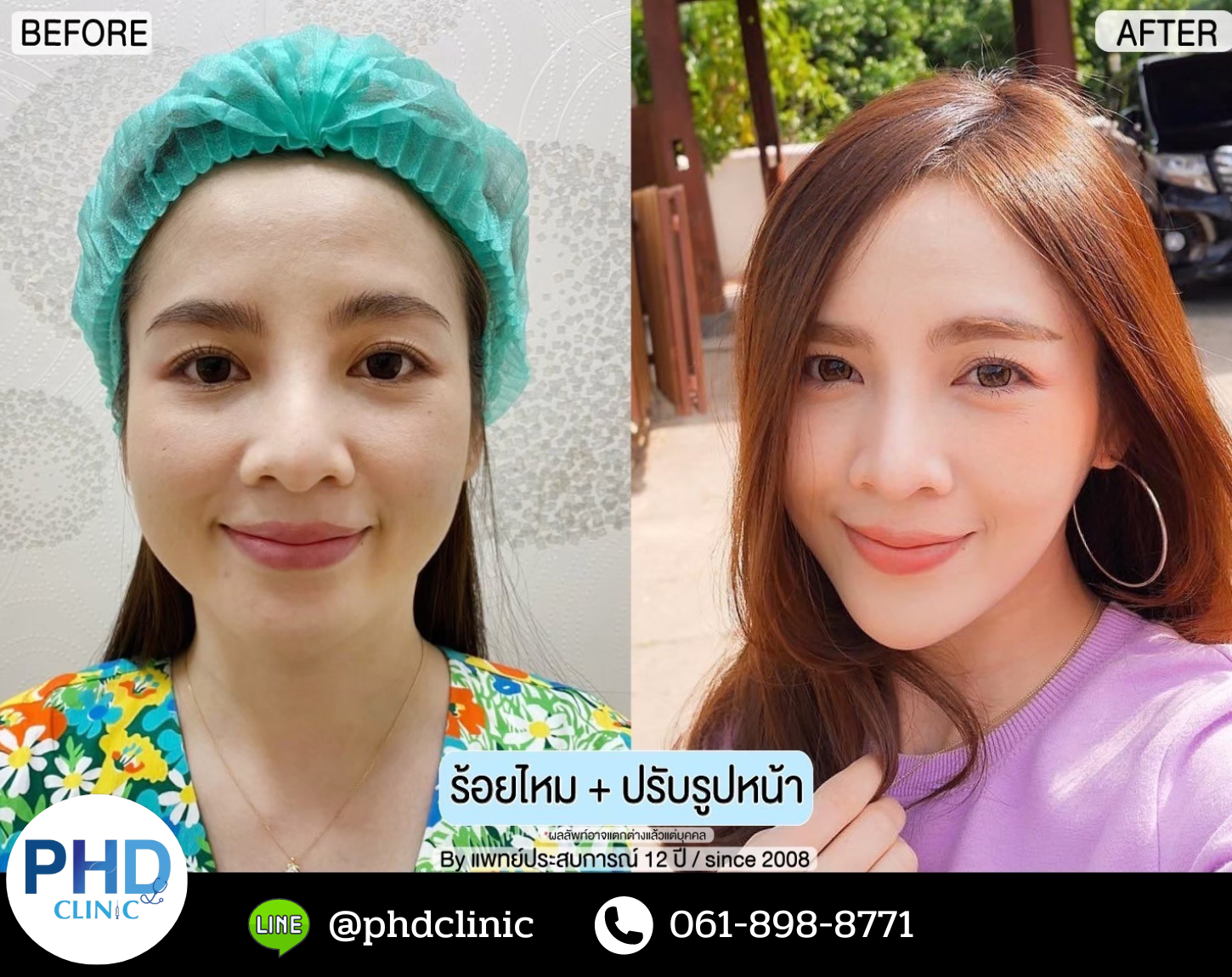 ร้อยไหม