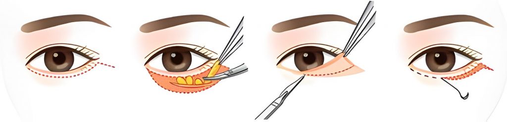 Lower Blepharoplasty