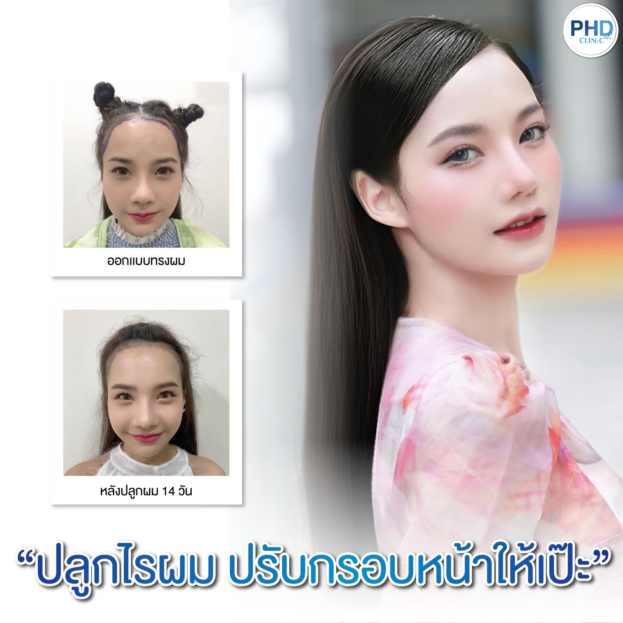 ปลูกผม Long Hair ที่ไหนดี ปลูกผม Long Hair ที่ไหนดี