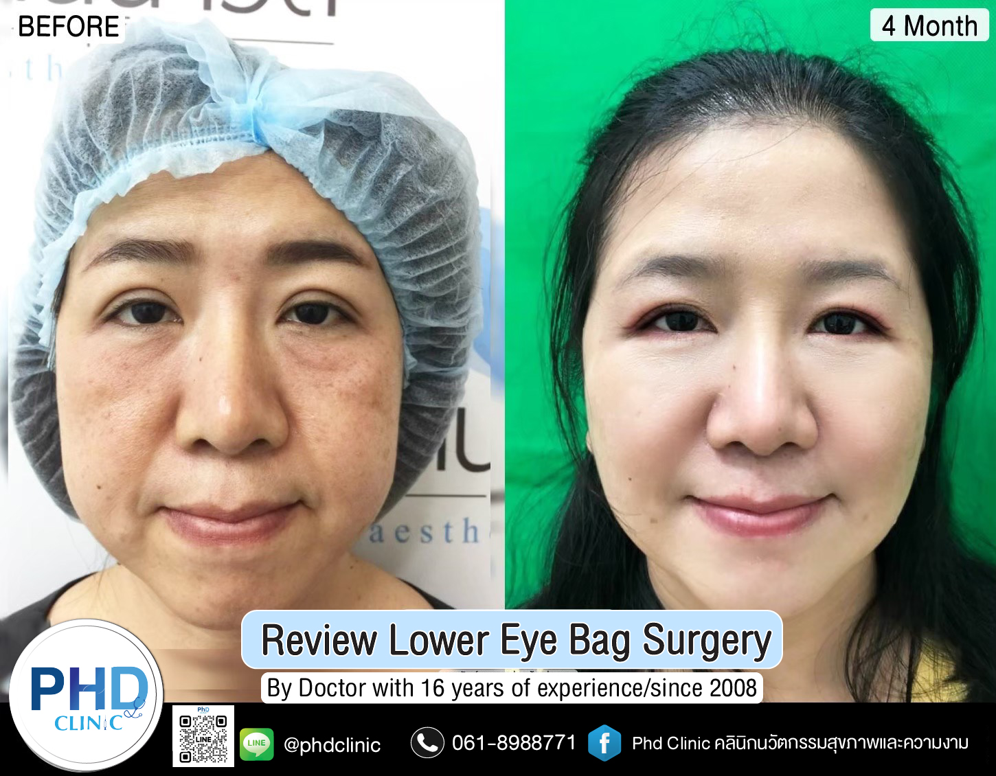 Lower Eye Bag Surgery Pattaya Lower Eye Bag Surgery Pattaya