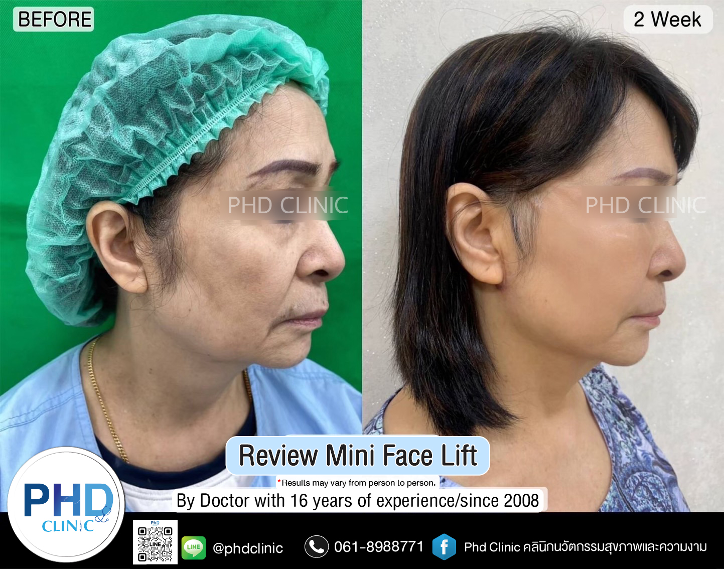 https://www.phd-hairtransplant.com/mini-face-lift-surgery-pattaya/