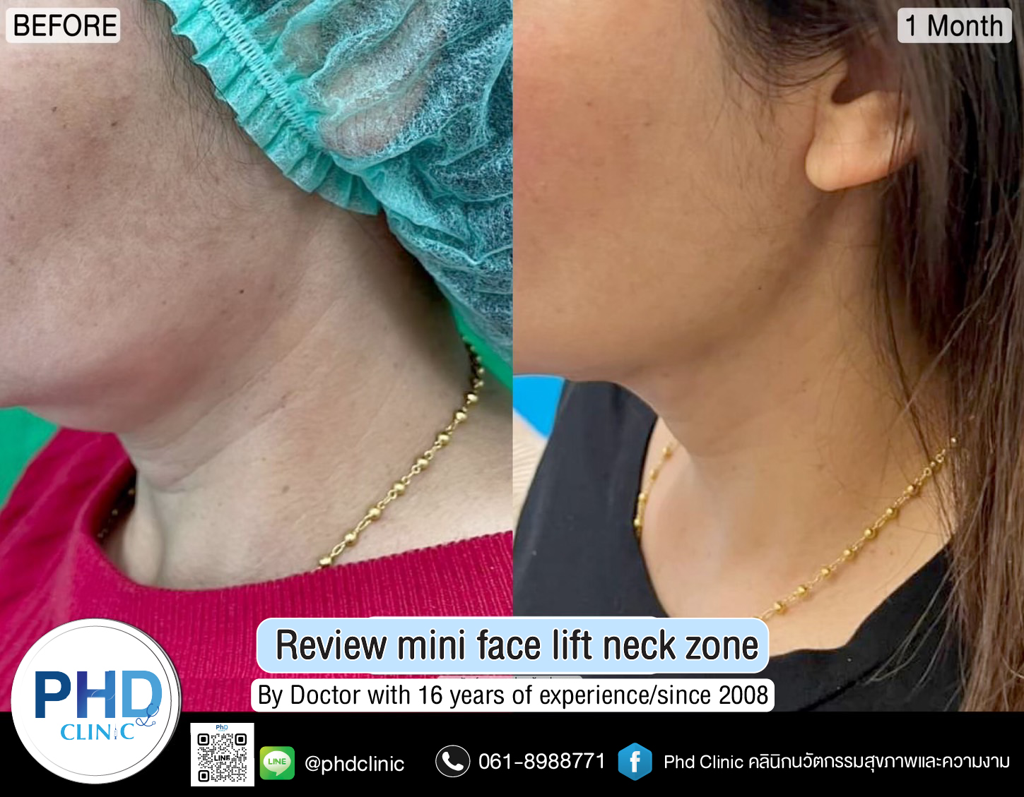 mini face lift mini face lift