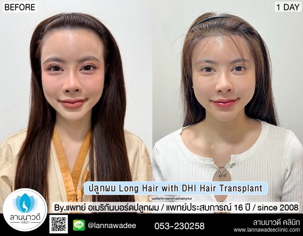 Long Hair Transplant