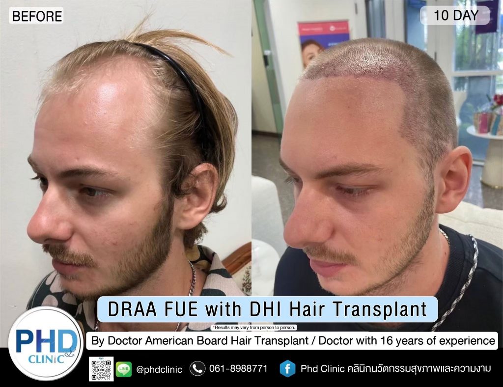 Frontal hairline transplant
