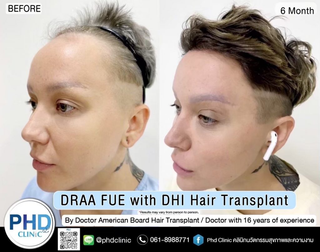 Frontal hairline transplant