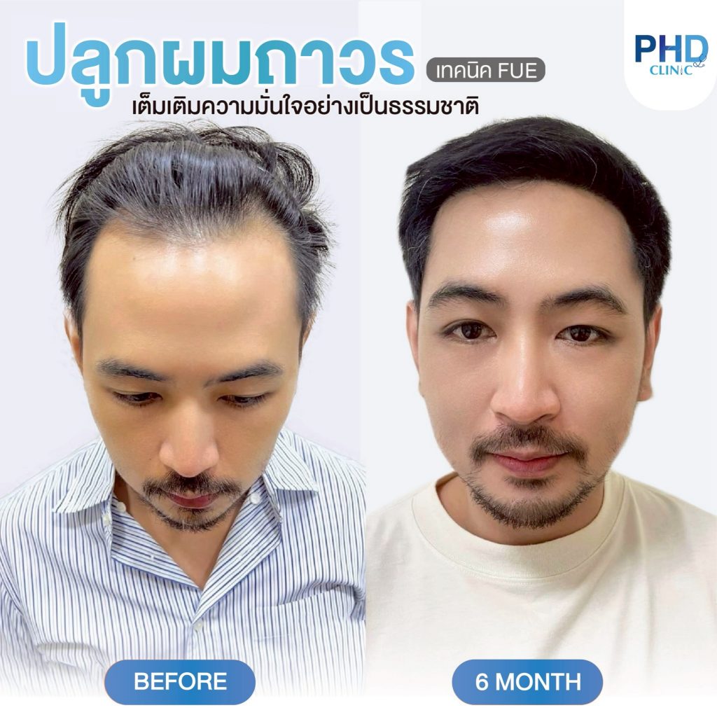 ปลูกผม