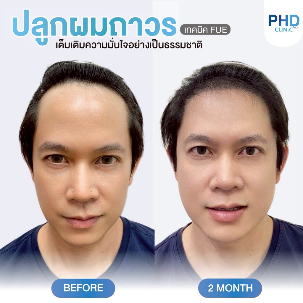 ปลูกผม