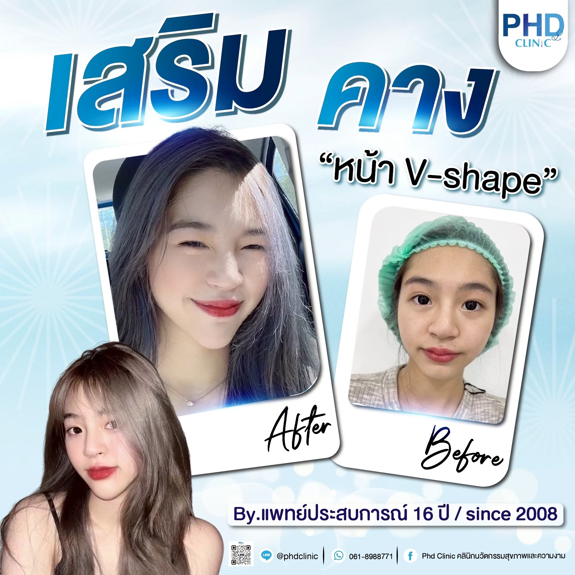เสริมคาง