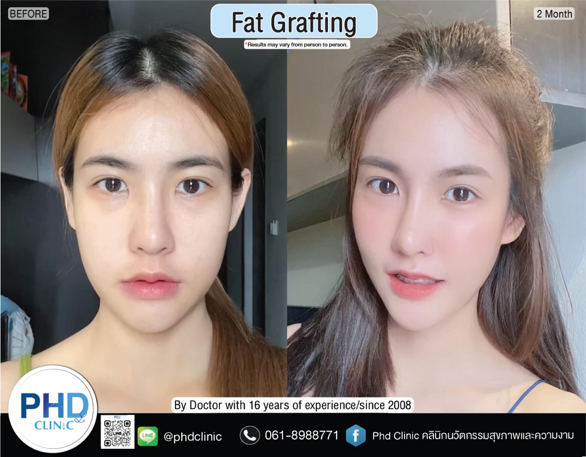 fat เติมไขมัน