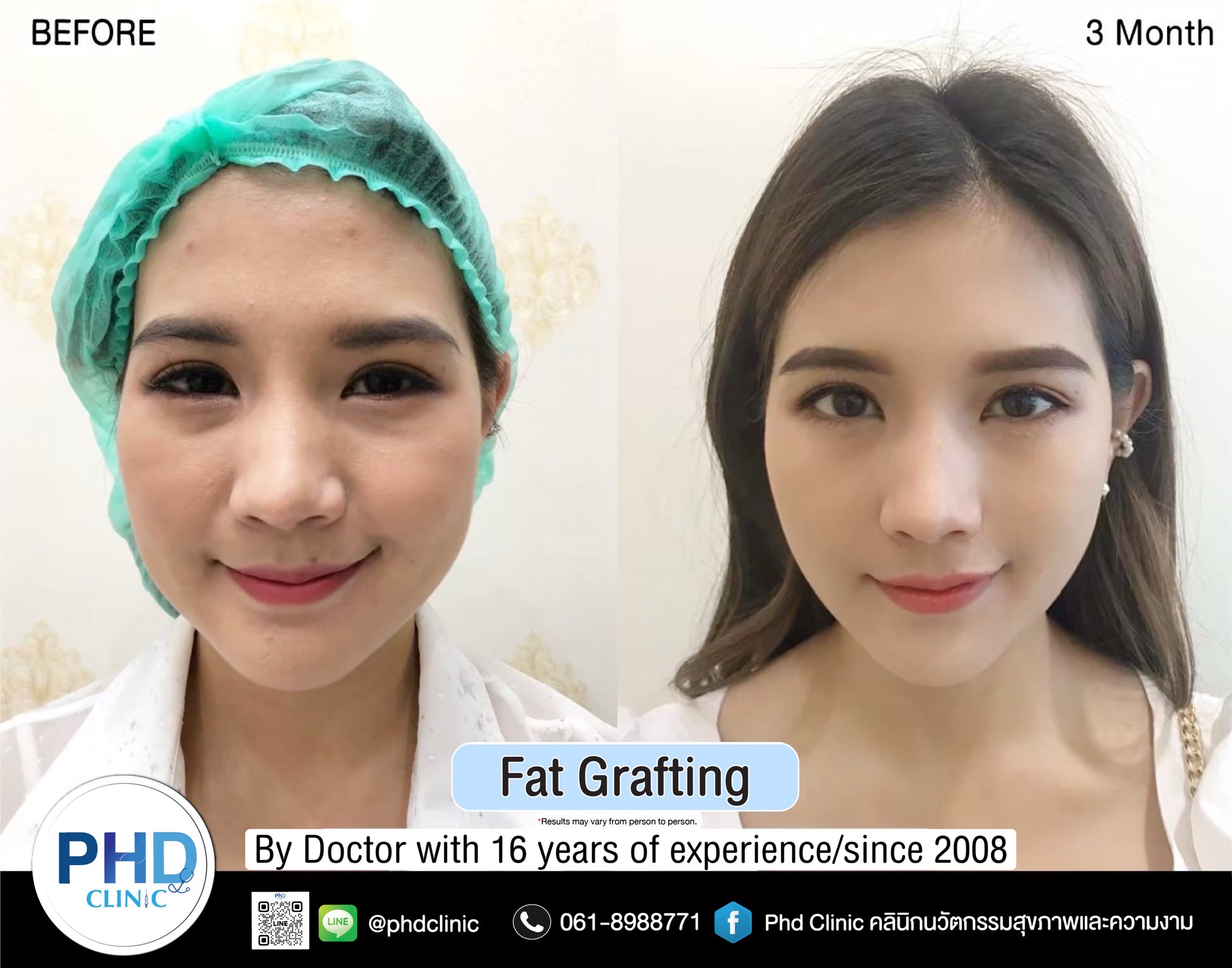 Fat Grafting Phuket