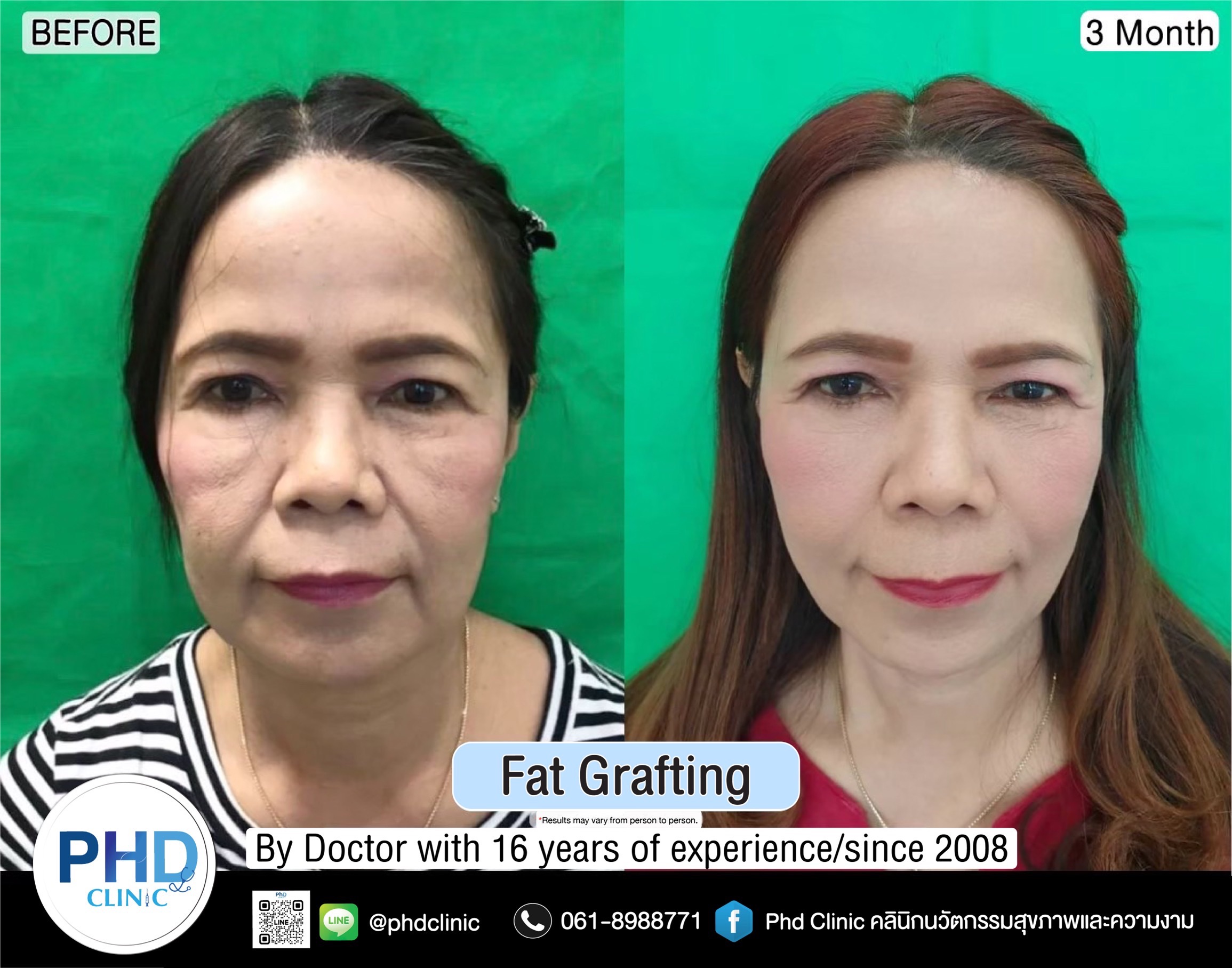 Fat Grafting Phuket