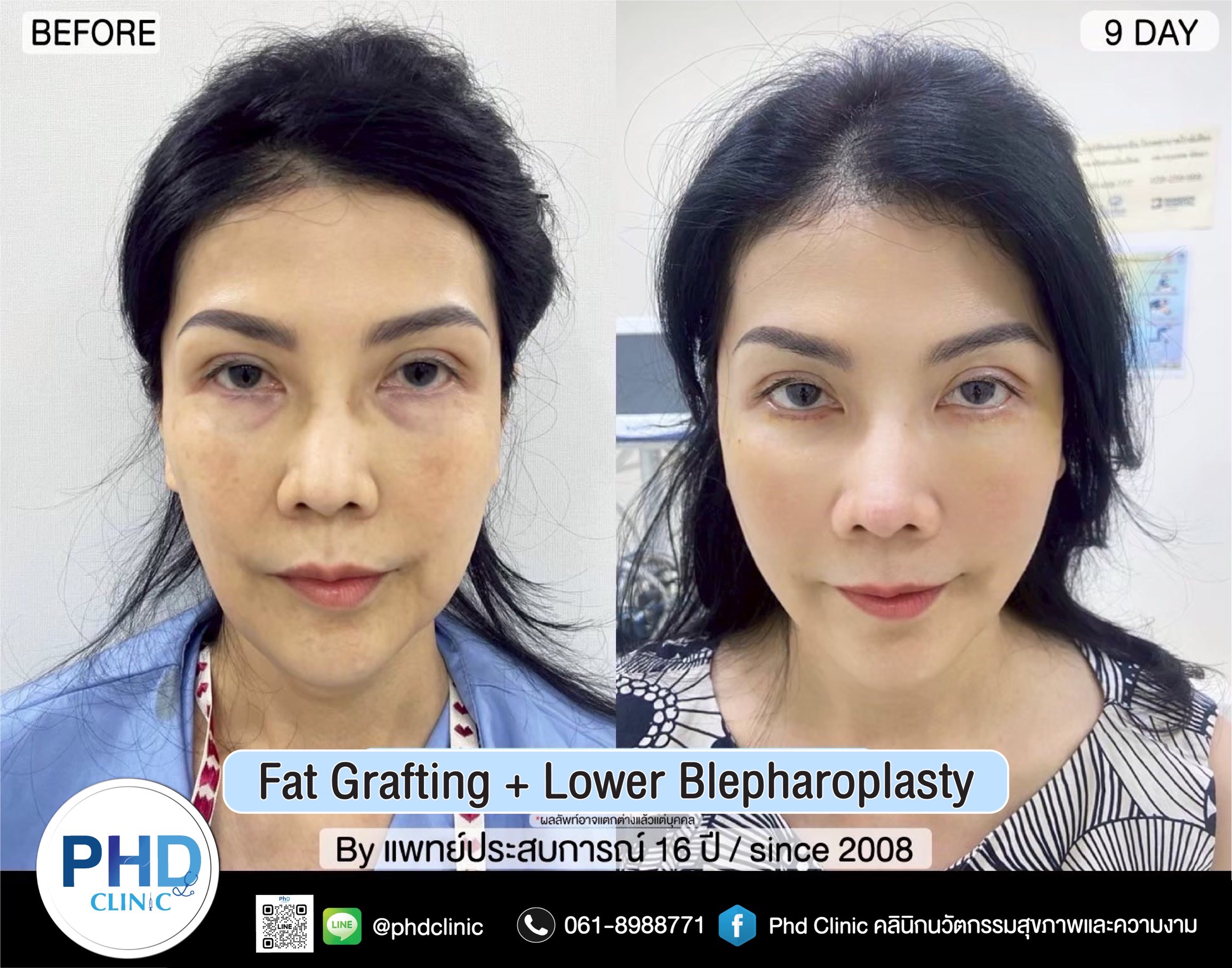 Fat Grafting Phuket
