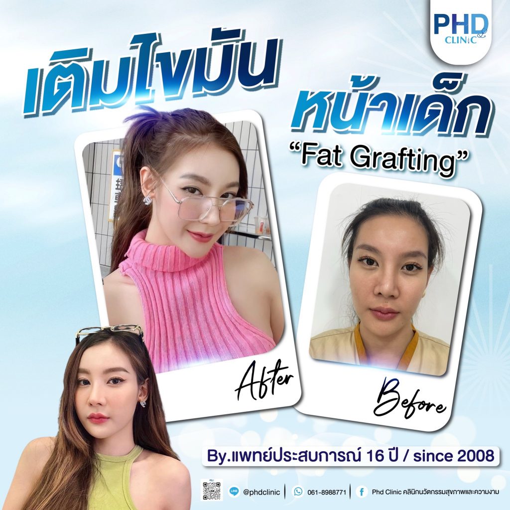 Fat Grafting Phuket