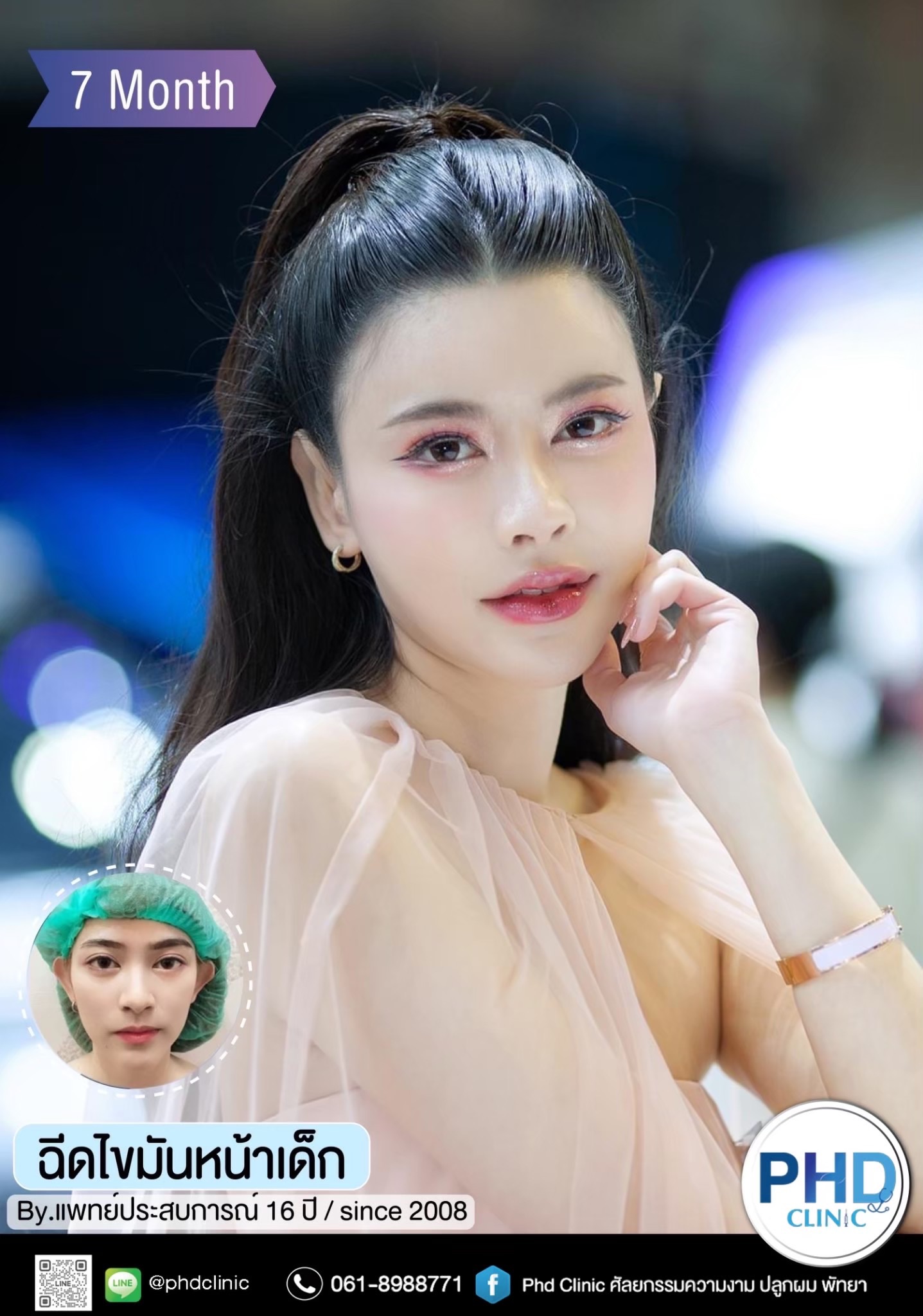 ฉีด fat หน้า พัทยา