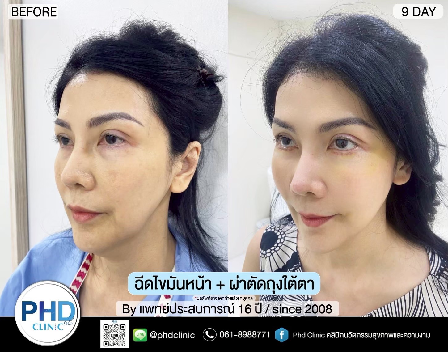 ฉีด fat หน้า