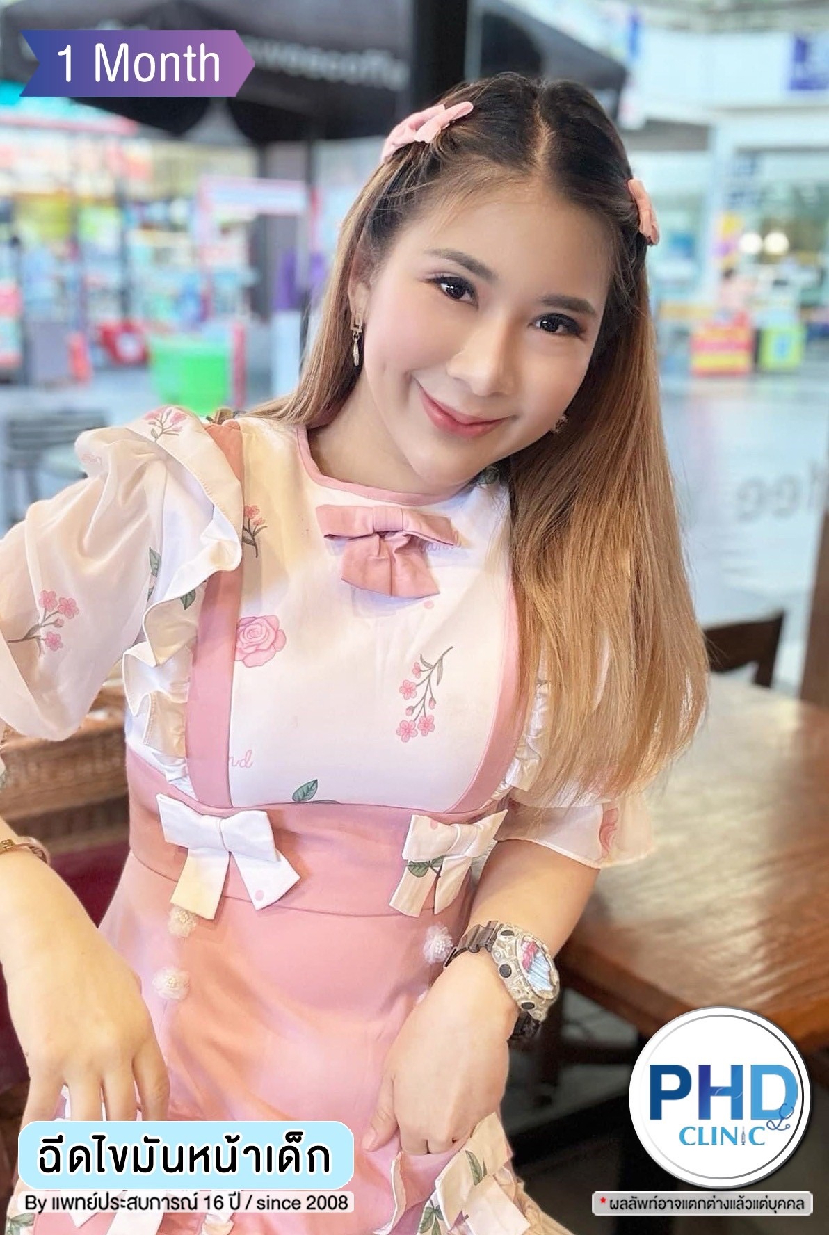 ฉีด fat หน้า