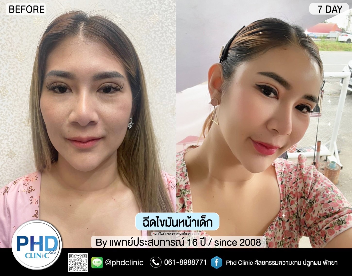 ฉีด fat หน้า