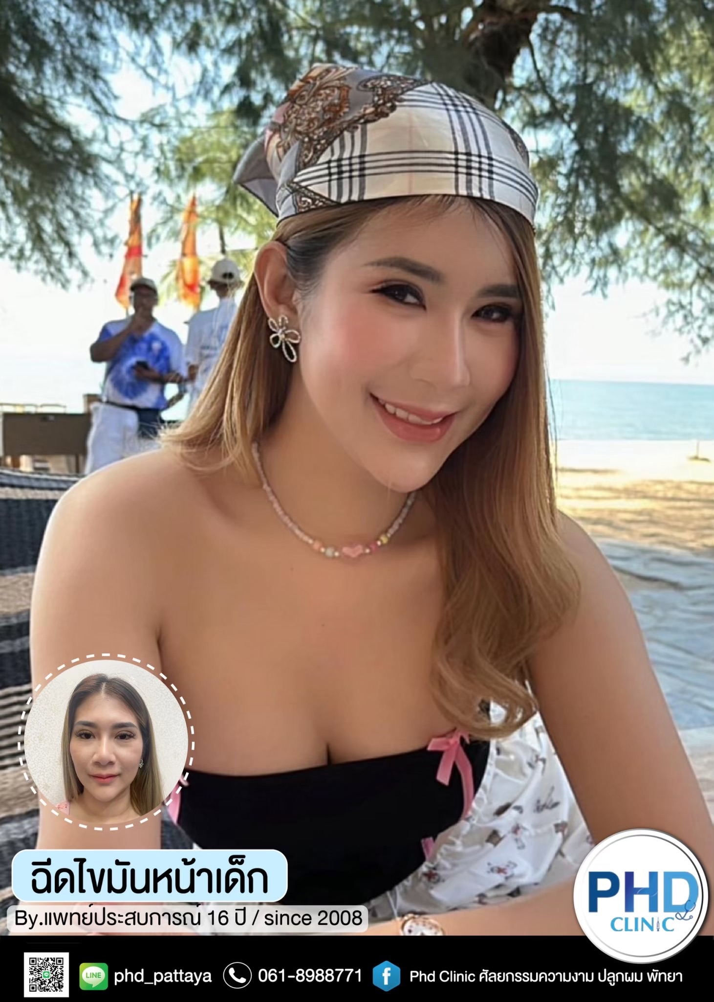 ฉีด fat หน้า