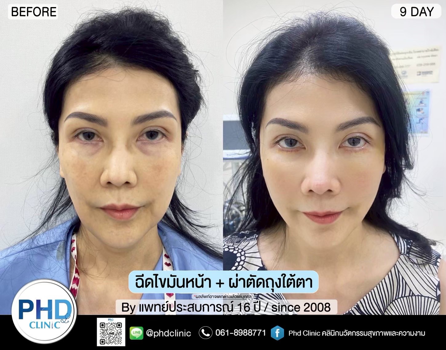 ฉีด fat หน้า