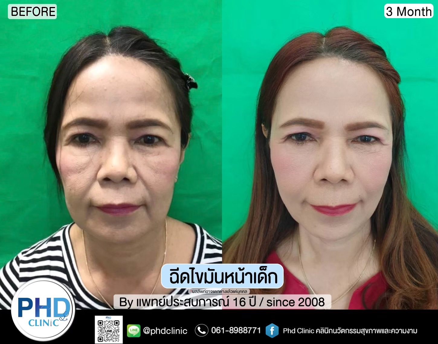 ฉีด fat หน้า