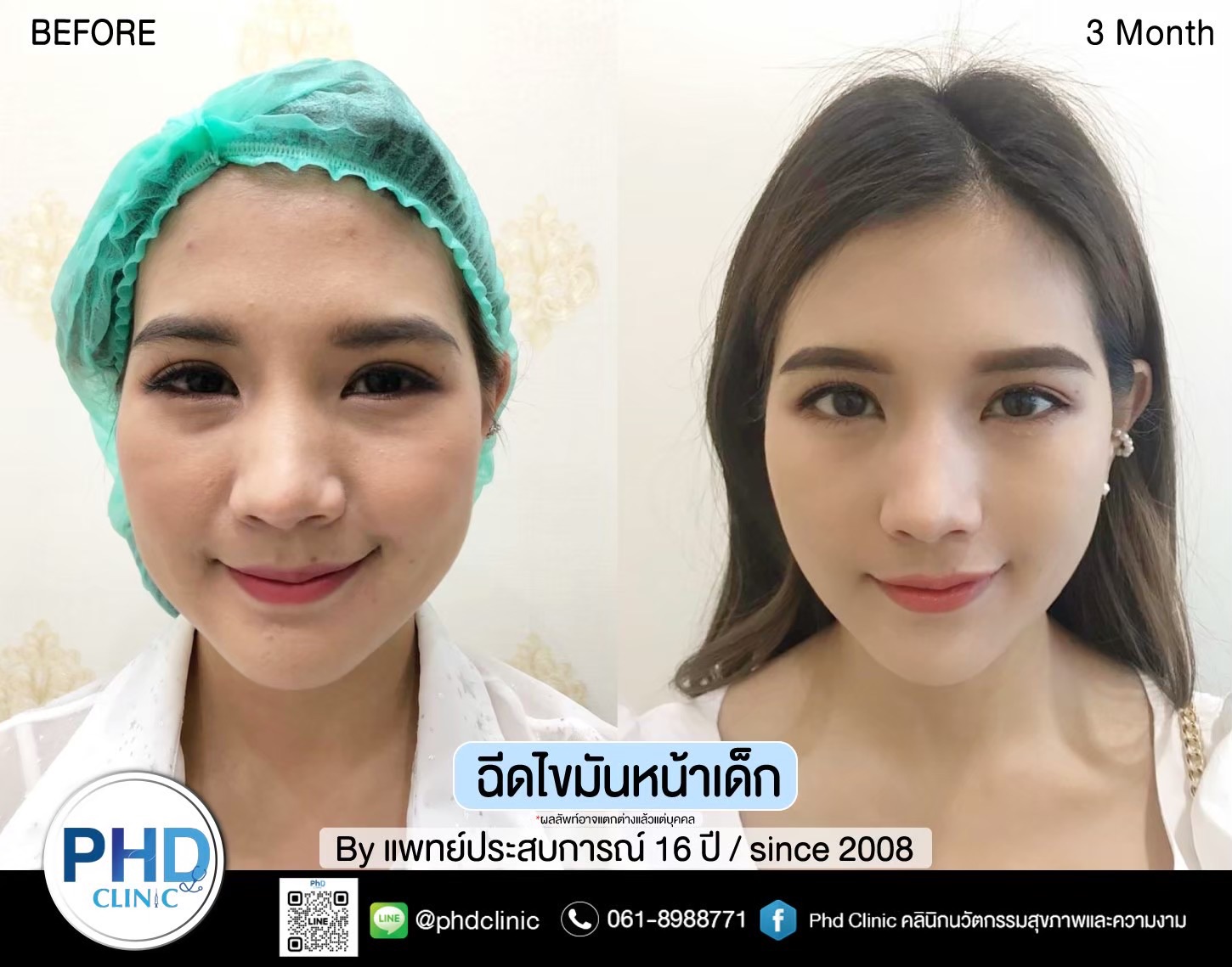 ฉีด fat หน้า