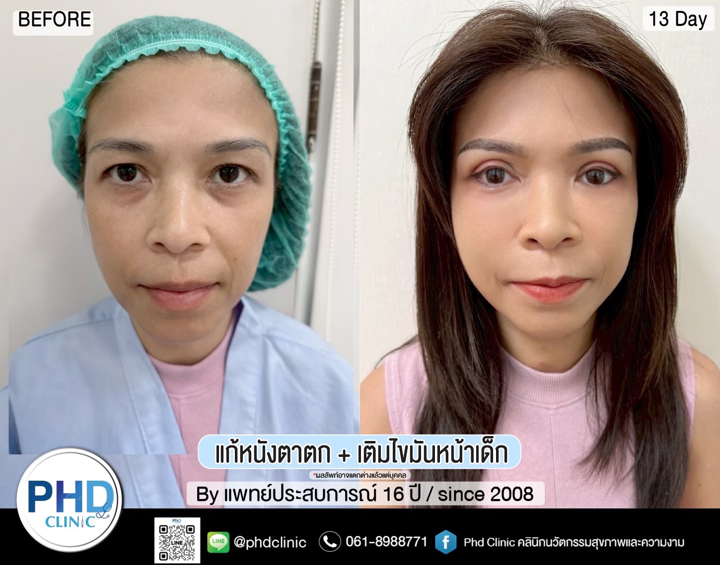 ฉีด fat หน้า ฉีด fat หน้า