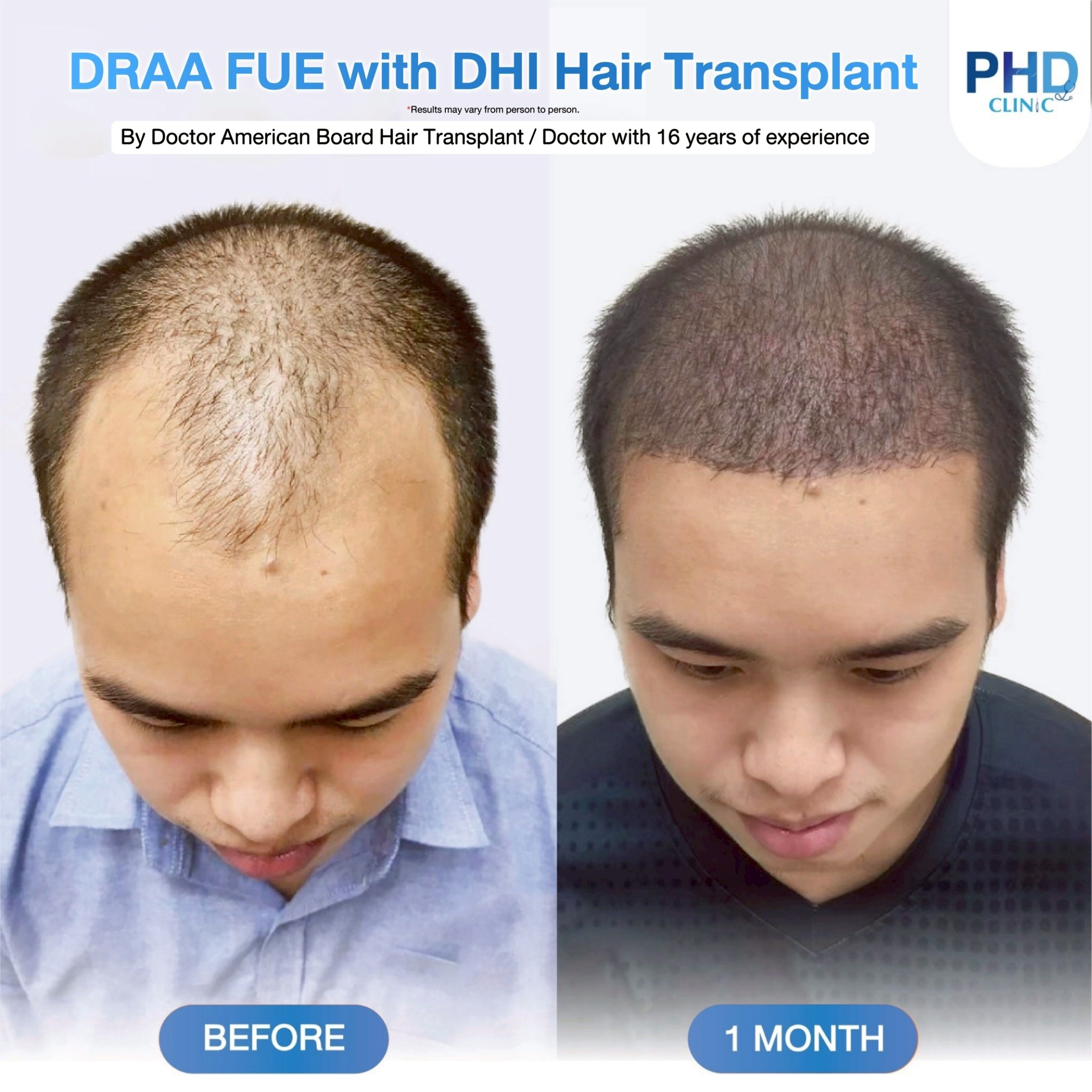 ABHRS hair transplant Thailand