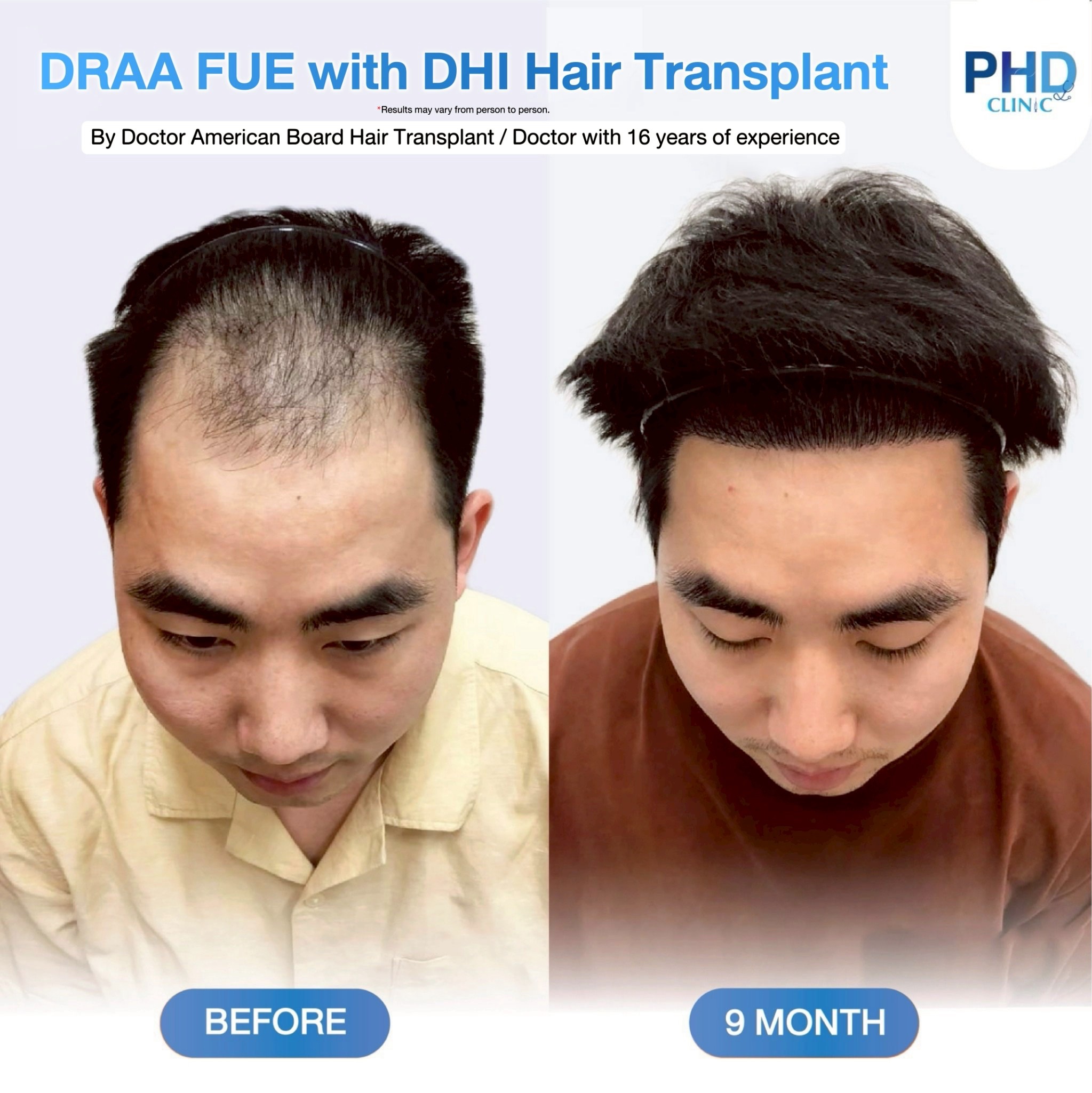 ABHRS hair transplant Thailand