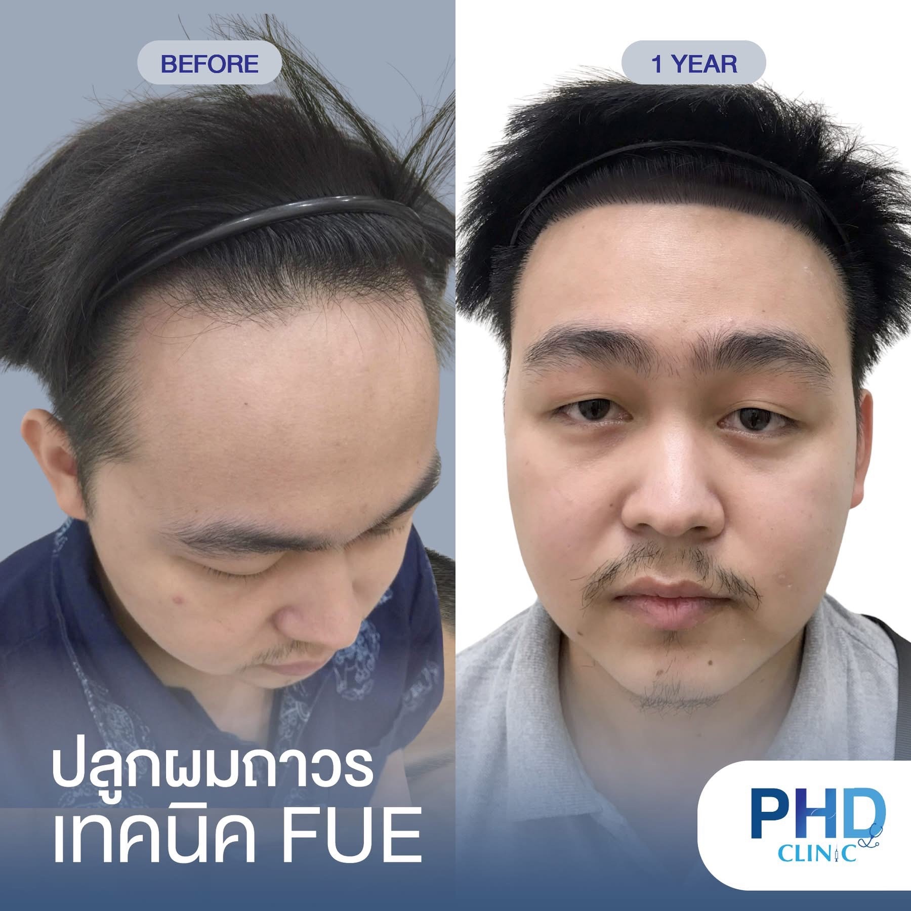 ABHRS hair transplant Thailand