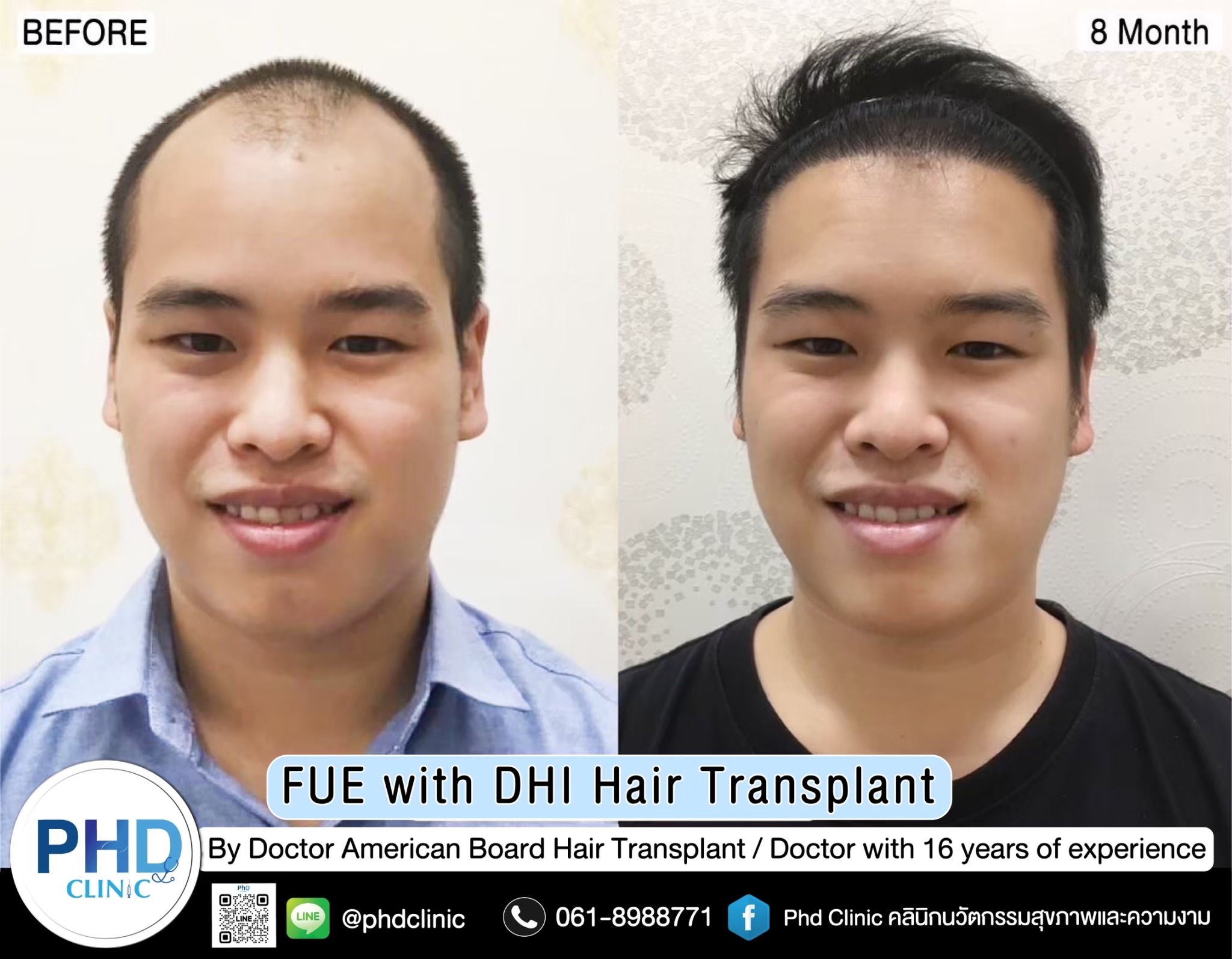 ABHRS hair transplant Thailand