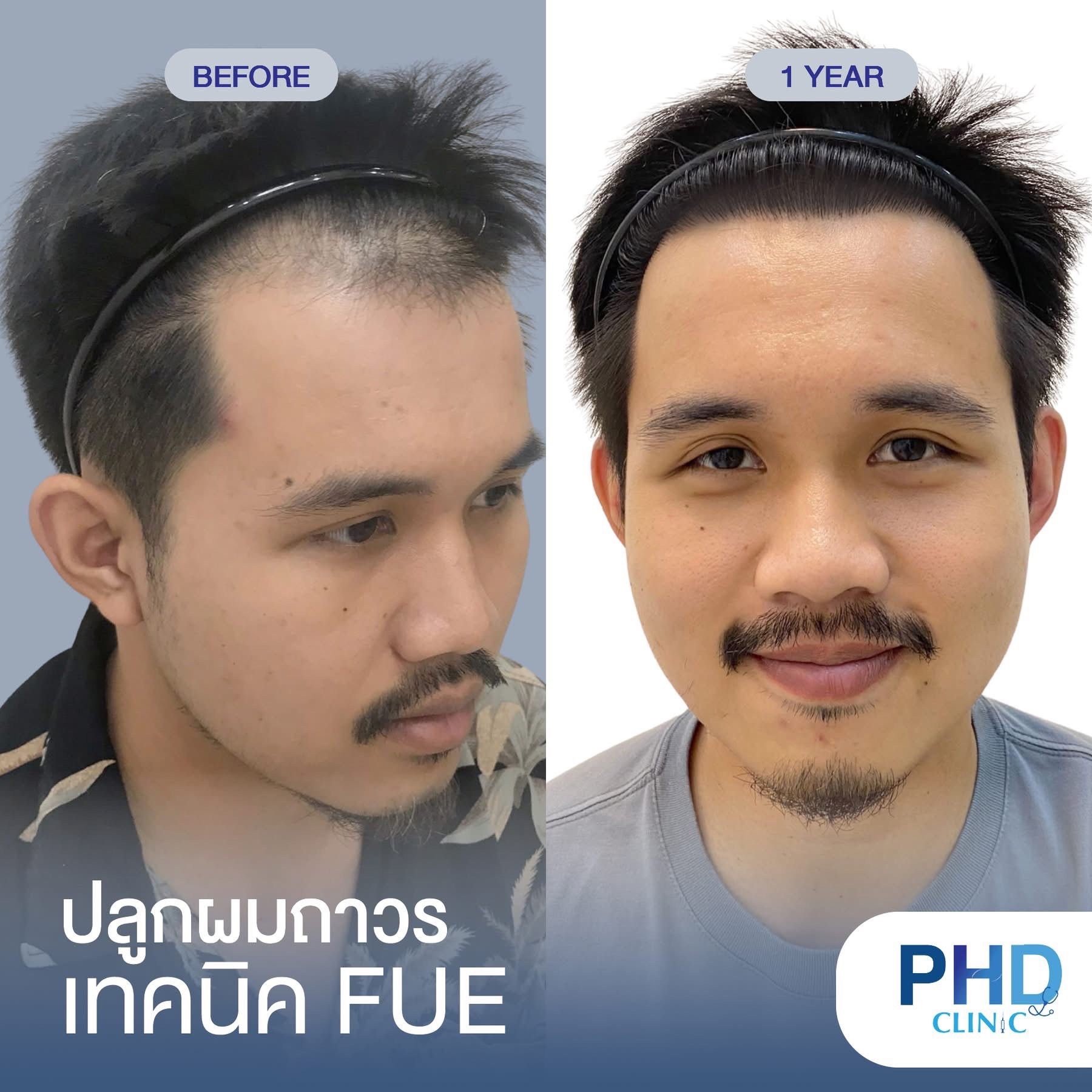 ABHRS hair transplant Thailand