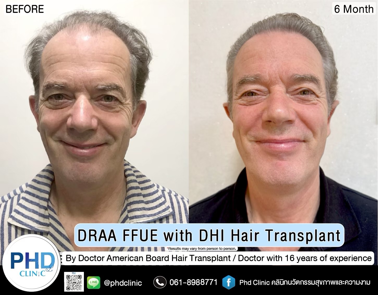 ABHRS hair transplant Thailand