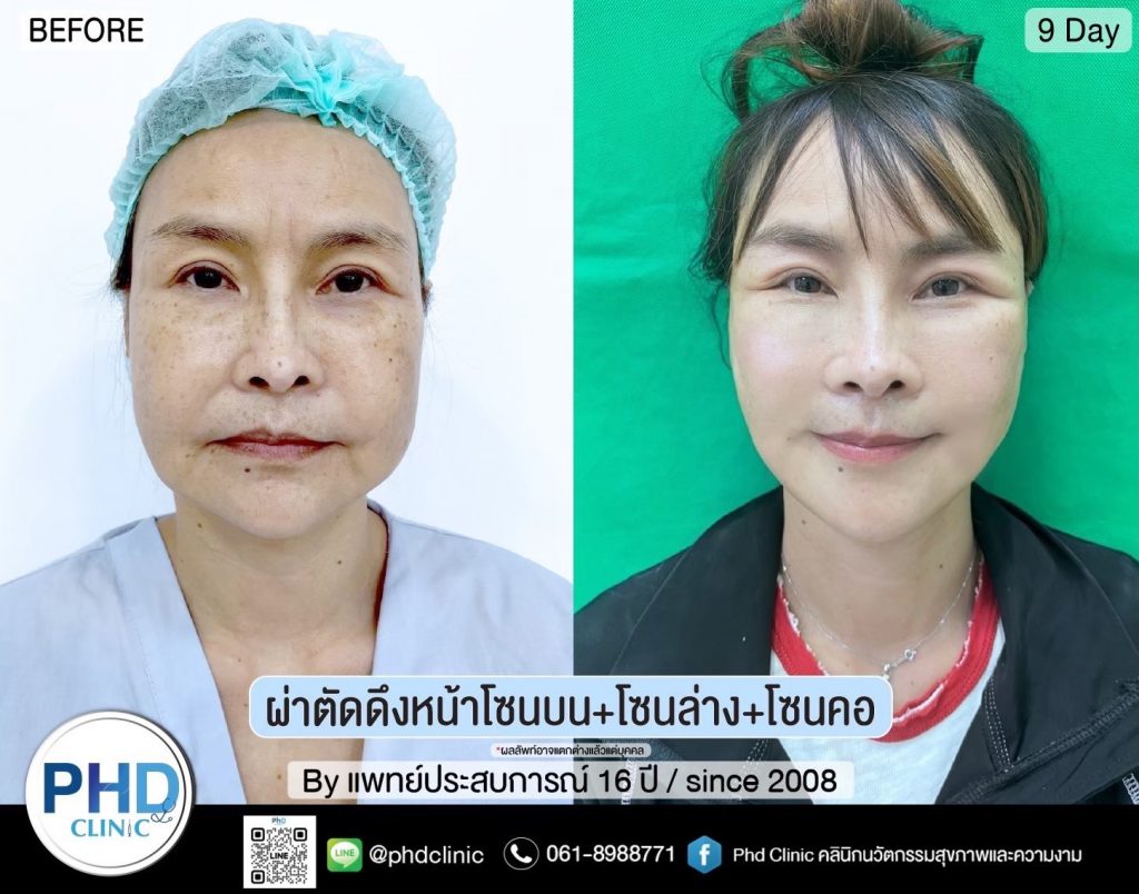 ผ่าตัดดงหน้า