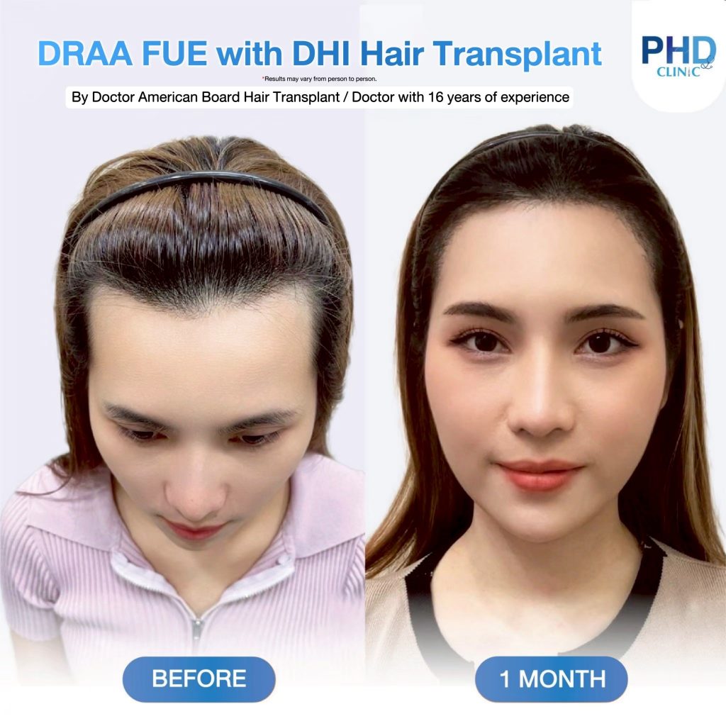 Hair Transplant