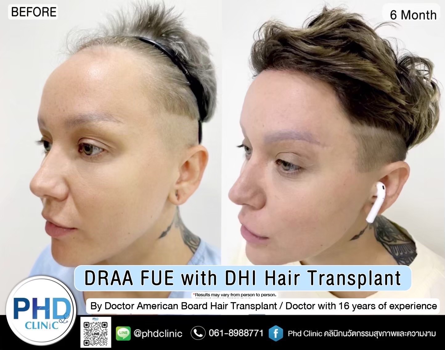 Hair transplant Bangkok