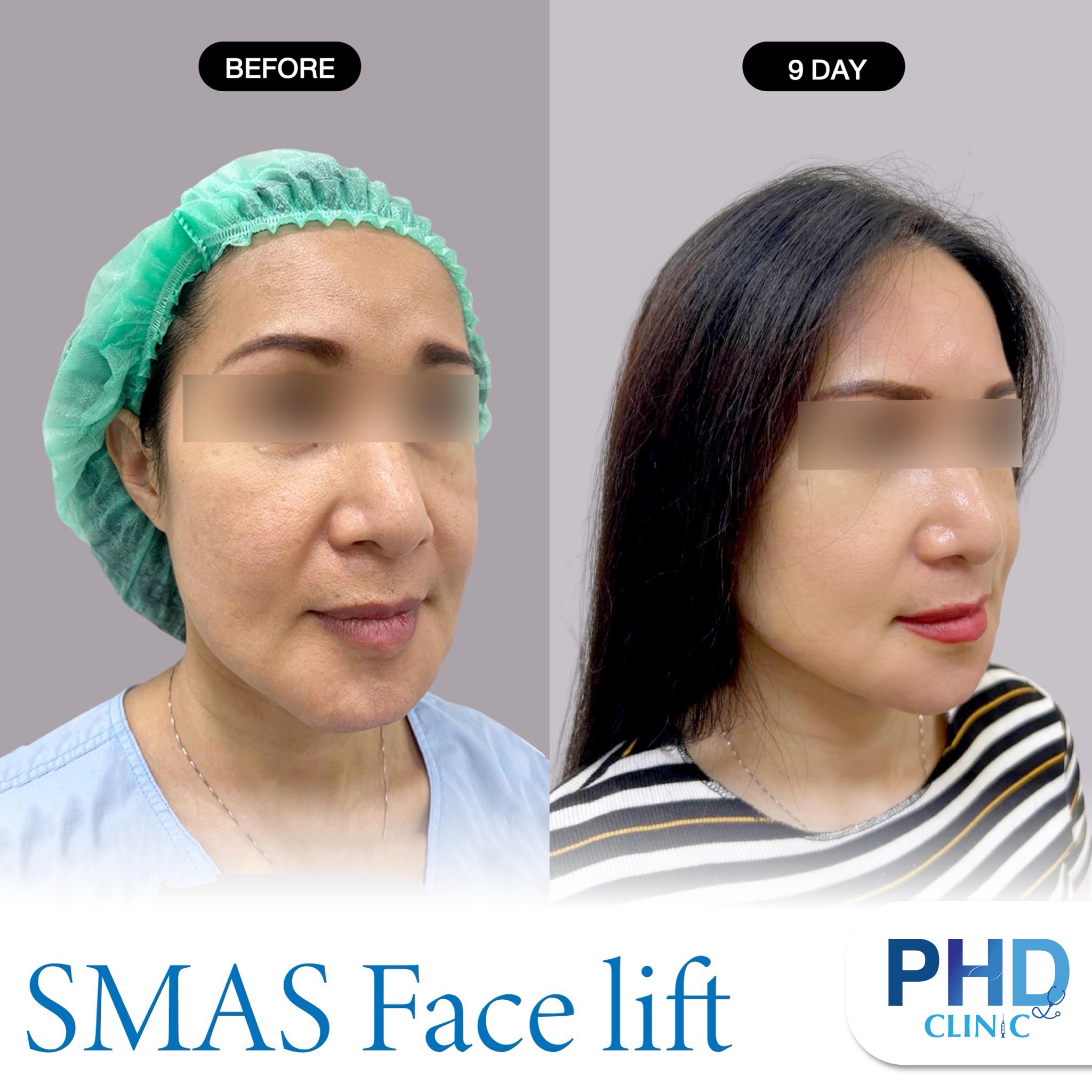 Facelift Surgery