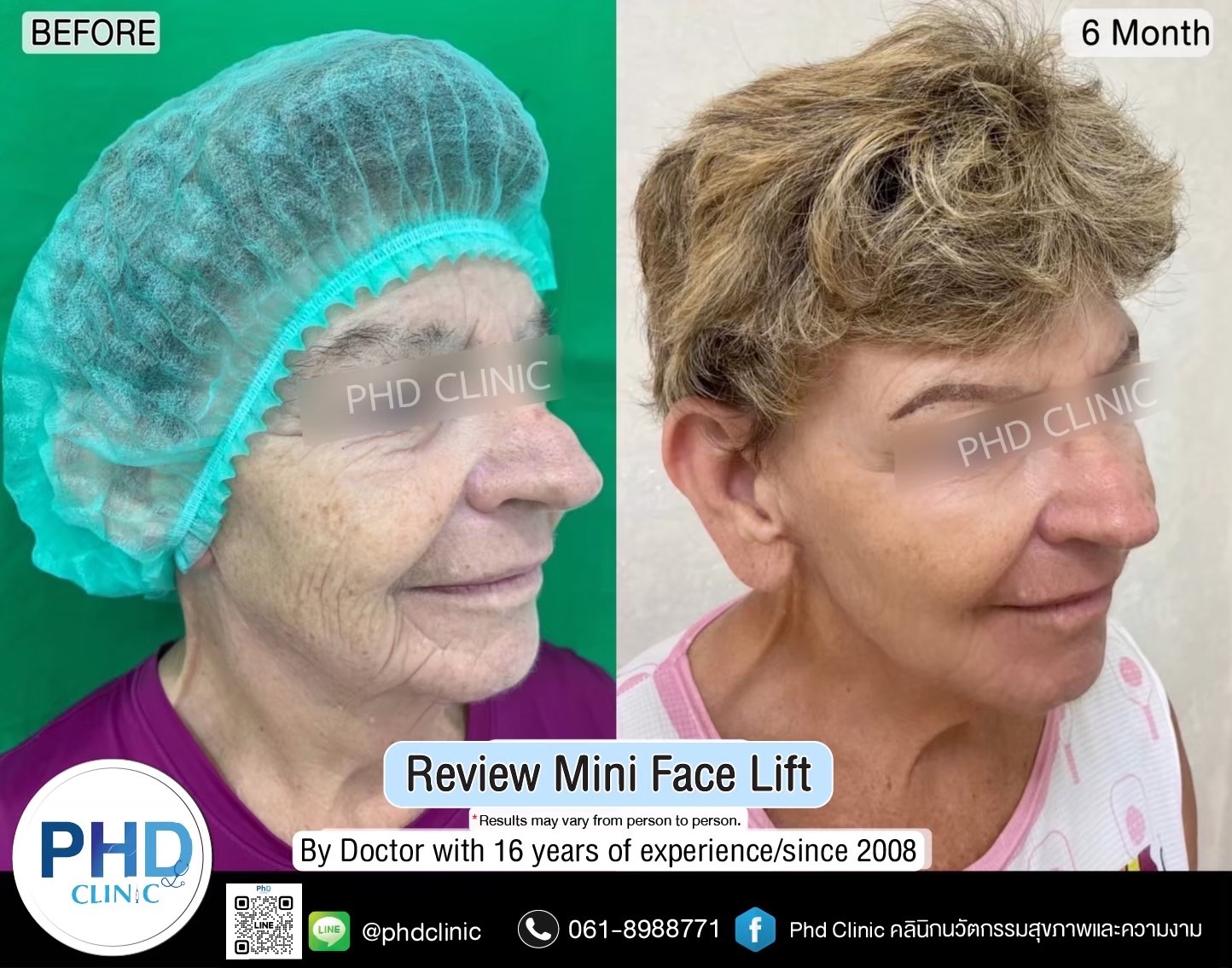 Facelift Surgery Phuket