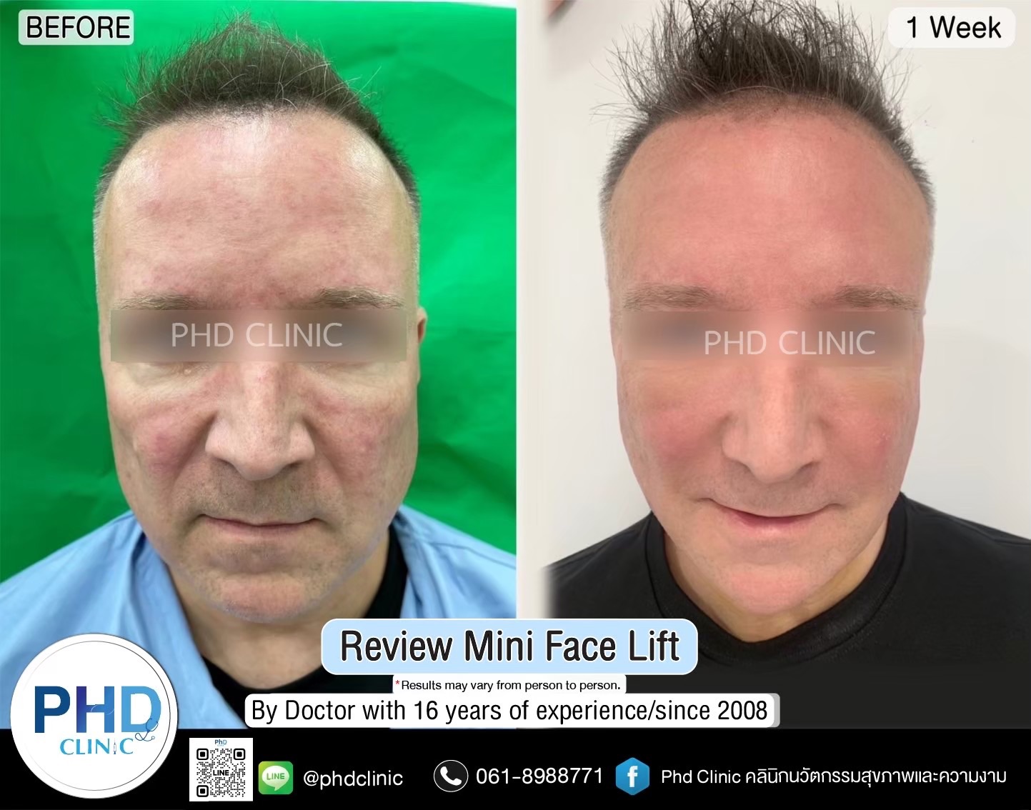 Facelift Surgery Phuket