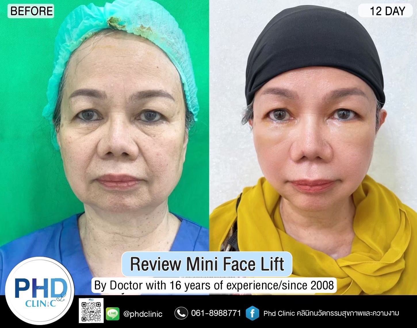 review Facelift Surgery Phuket 2026