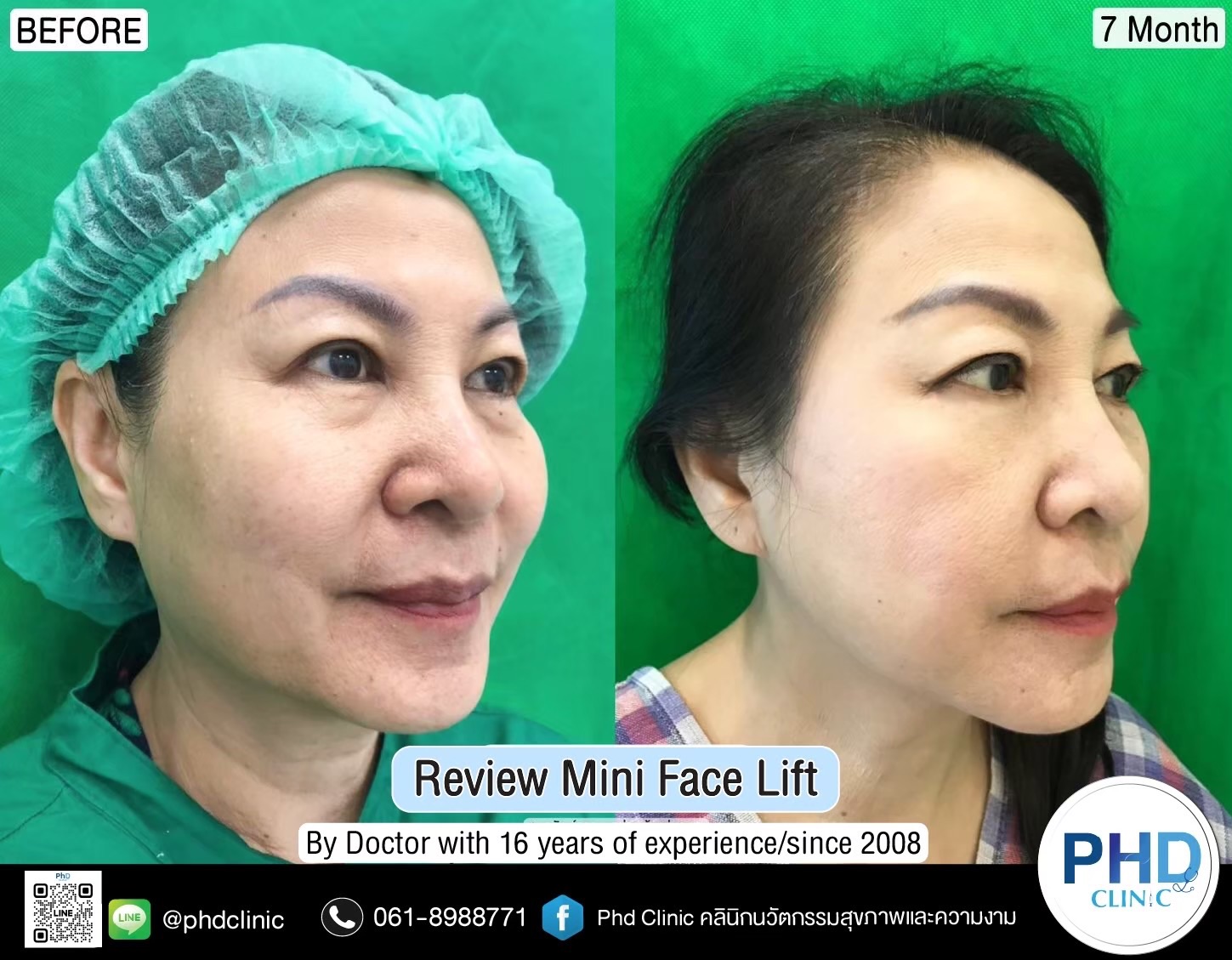 review Facelift Surgery Phuket