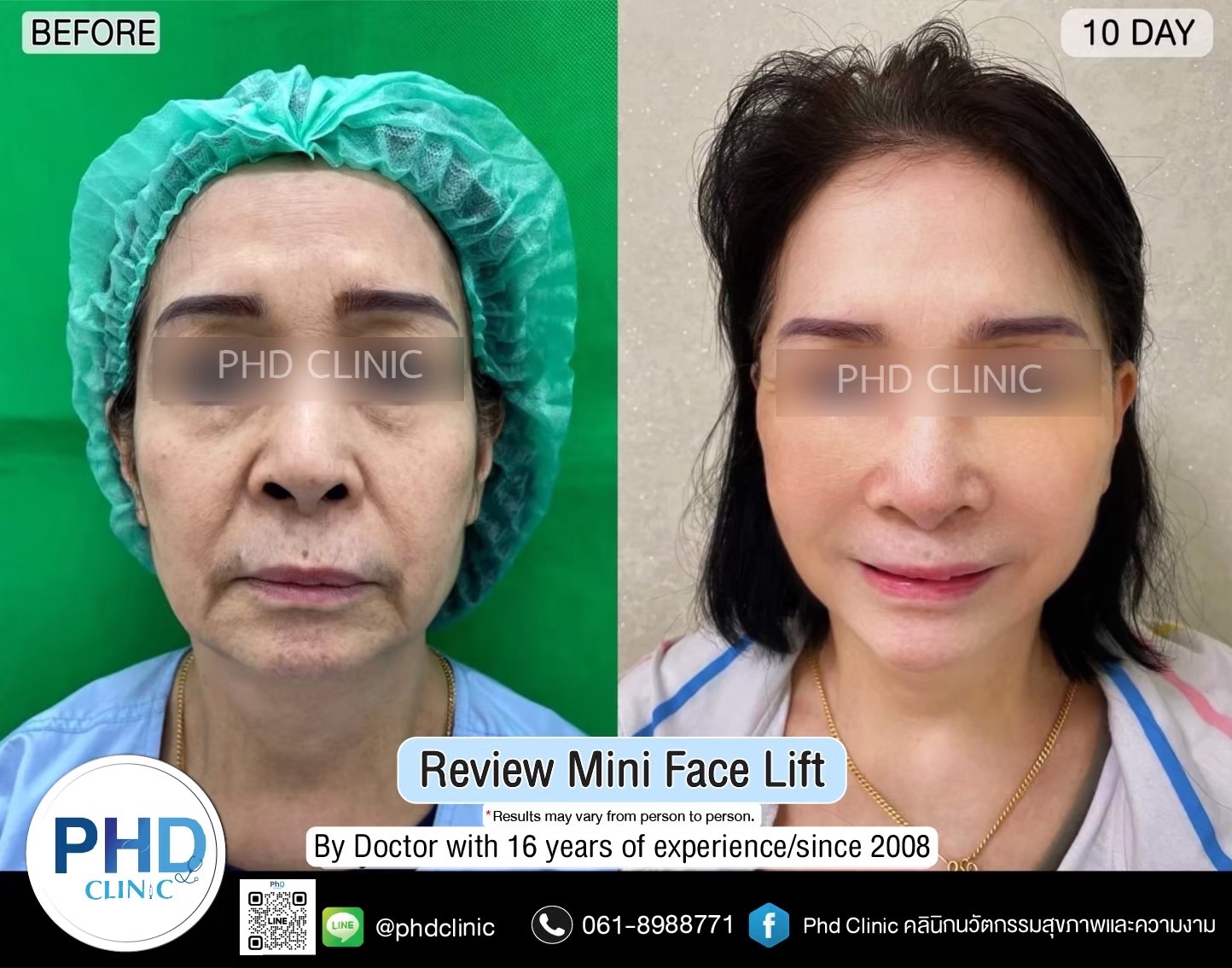 review Facelift Surgery Phuket