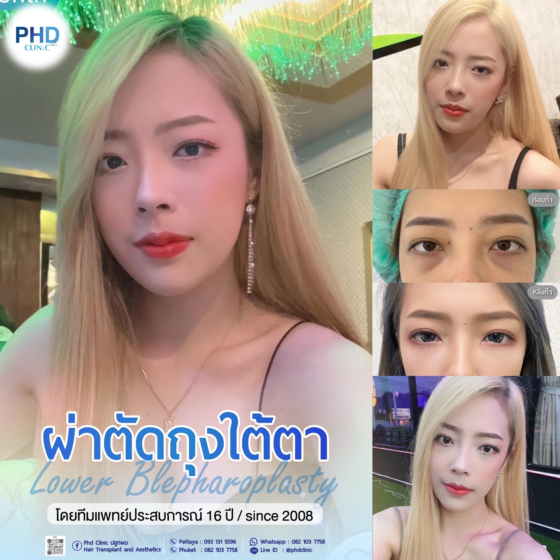 ผ่าตัดถุงใต้ตาพัทยา