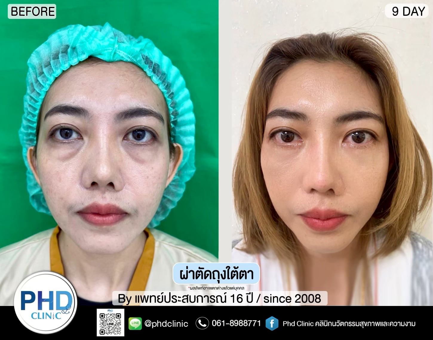 ผ่าตัดถุงใต้ตาภูเก็ต