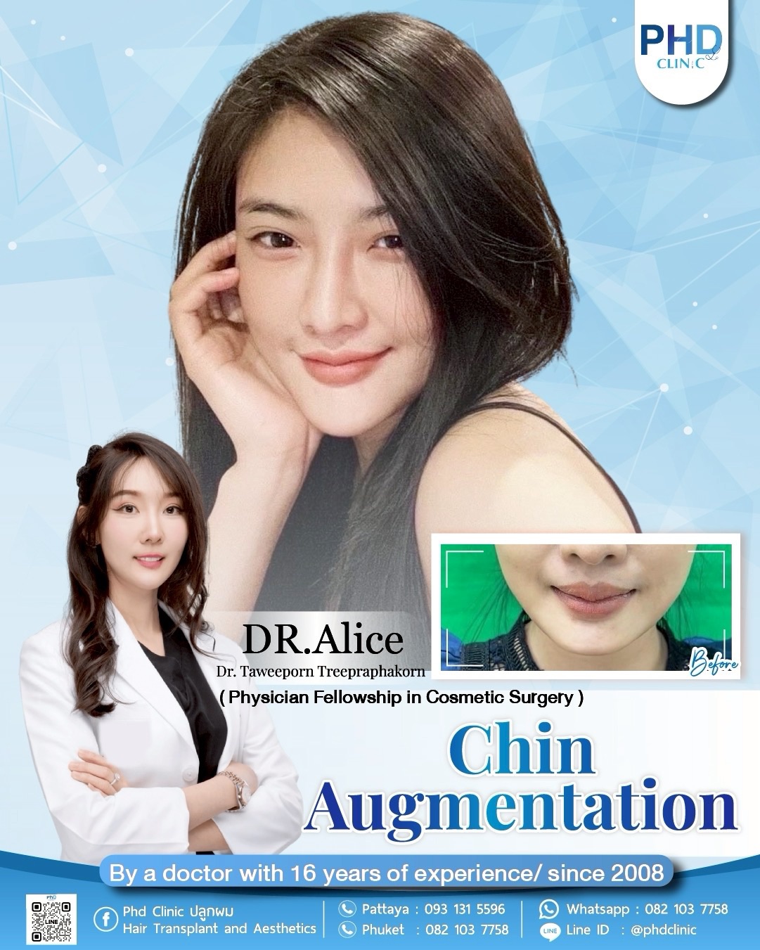 Chin augmentation in Pattaya