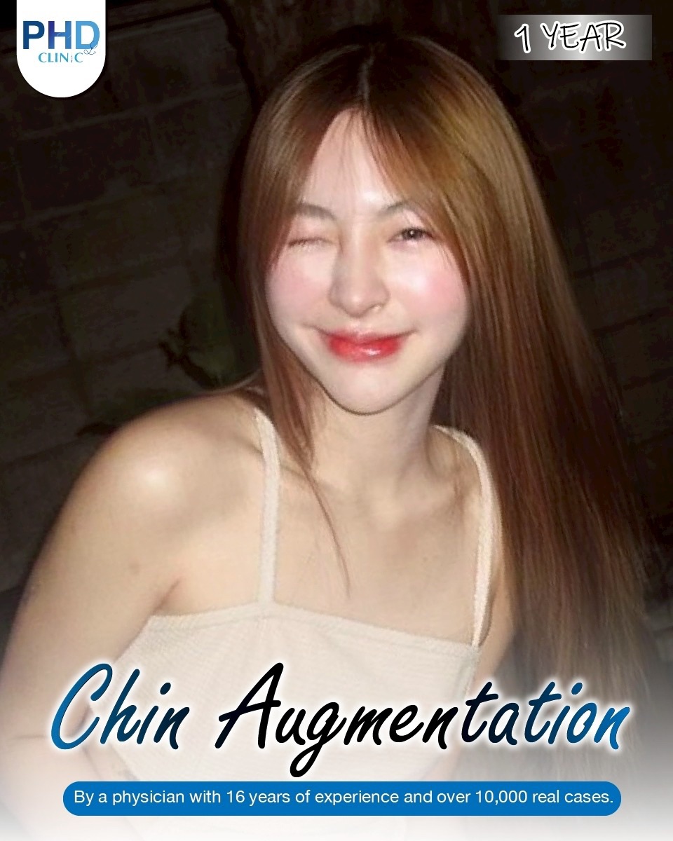 Chin augmentation phuket